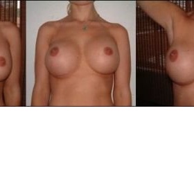 Pokles jednoho implantátu - tzv. bottoming out