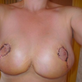 Jak na strupy po redukci a modelaci prsou