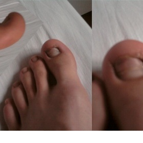 Zkroucené palce na nohou, nehty rostou vzhůru