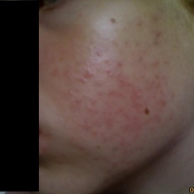 Vyrážka jen na tvářích