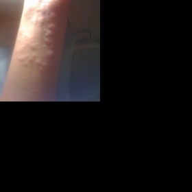 Popálení od kopřivy - jak se zbavit svědění