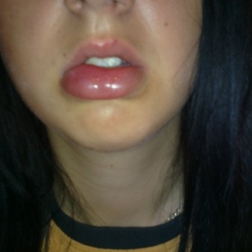 Nateklý spodní ret