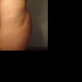 Prohlubně a jiné nerovnosti po liposukci boků - následná oprava