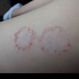 Kulatý ekzém na noze. Jak se léčí?