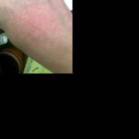 Vysoké horečky a vyrážka