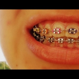 Barva gumiček(ligatur) na fixních rovnátkách - pro hnědovlásku