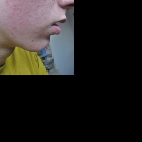 Rudé fleky na tvářích