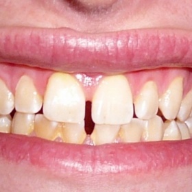 Mezera mezi zuby, rovnátka