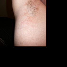 Suché podpaží, červené a podrážděné