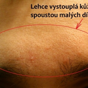 Jaký přípravek zvolit na zlepšení pleti v oblasti čela a tváří