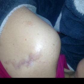 Jizva po odstranění tetování