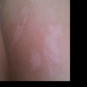 Bílé mapy po popálenině