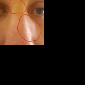 Měsíc po operaci tvrdého nosu