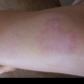 Odstranění jizvy - fotky před a po