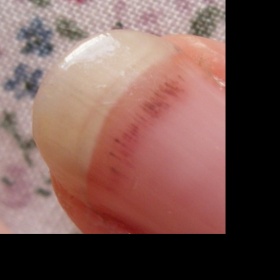 Alergická reakce na lak na nehty?