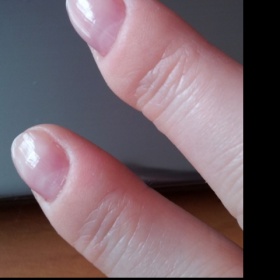 Zbytnělá a ztvrdlá kůže tvořící boule na prstech