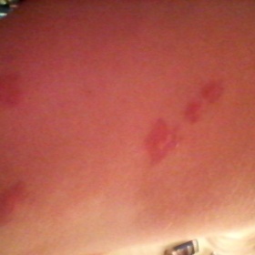 Červené štípance