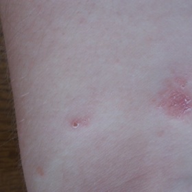 Vyrážka - štipnutie od mravca