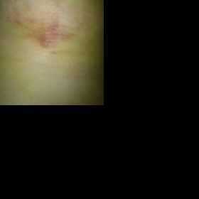 Zarudlá, rozlezlá jizva kvůli nevstřebaným stehům