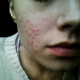 Jak nejlépe lečit akné bolavé a svědivé