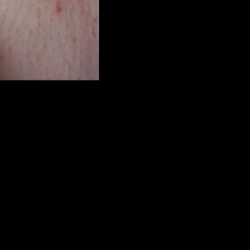 Červené pupínky, vyrážka v klíně