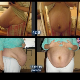Abdominoplastika po porodu