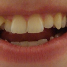 Trhání 4 zubů před rovnátky?