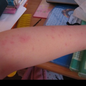 Vyrážka po depilačním krému