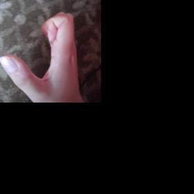 Bolest při semknutí prstou