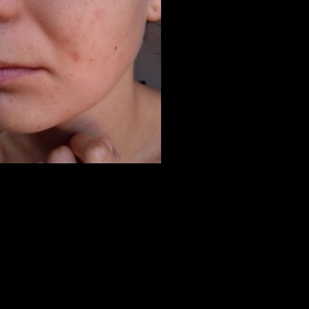 Zanesená pleť po vysazení antikoncepce