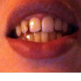 Dodělání zubu bílou blombou? Kam v Praze jít?