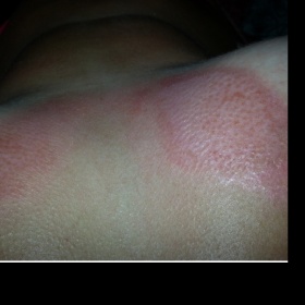 Růžové mapky na prsou po spálení sluncem