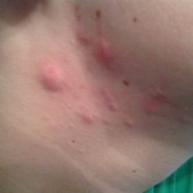 Co pomůže na těžké akné - velké hrboly?