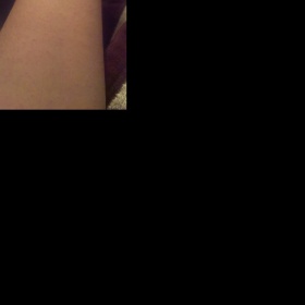 Vyrážka ruce, dekolt, krk