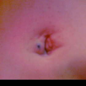 Jizva po pupeční kýle