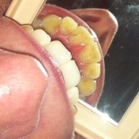 Kaz či zubní kámen?