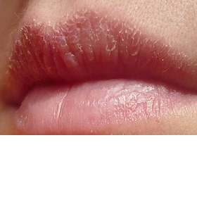 Ze dne na den popraskaný horní ret