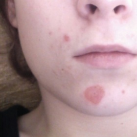 Akné se strupem - mokvající rány