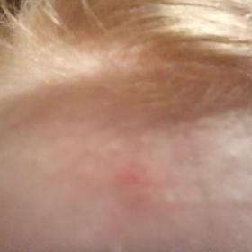 Akné - otevřený bolák