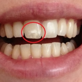 Jak odstranit fluoridové skvrny na zubech?