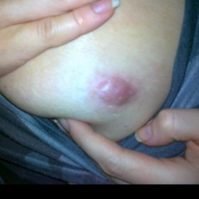 Viditelný, bolestivý pupínek