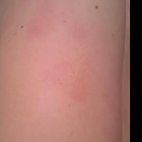 Zarudlé svědivé a suché fleky na pažích