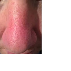 Chemický peeling na rozšírené póry