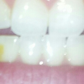 Prasklý a zanesený zub