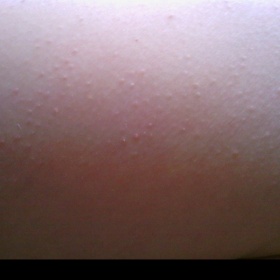 Vyrážky na stehnách