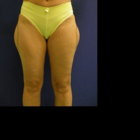 "Boule" na vnější straně stehen