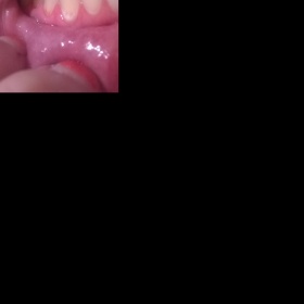 Nahnědlé kořeny zubů