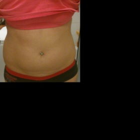 Lipo boky, břicho po augmentaci