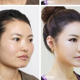 Operace zeštíhlující obličej