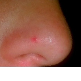 Žilka na nose - co s ní?